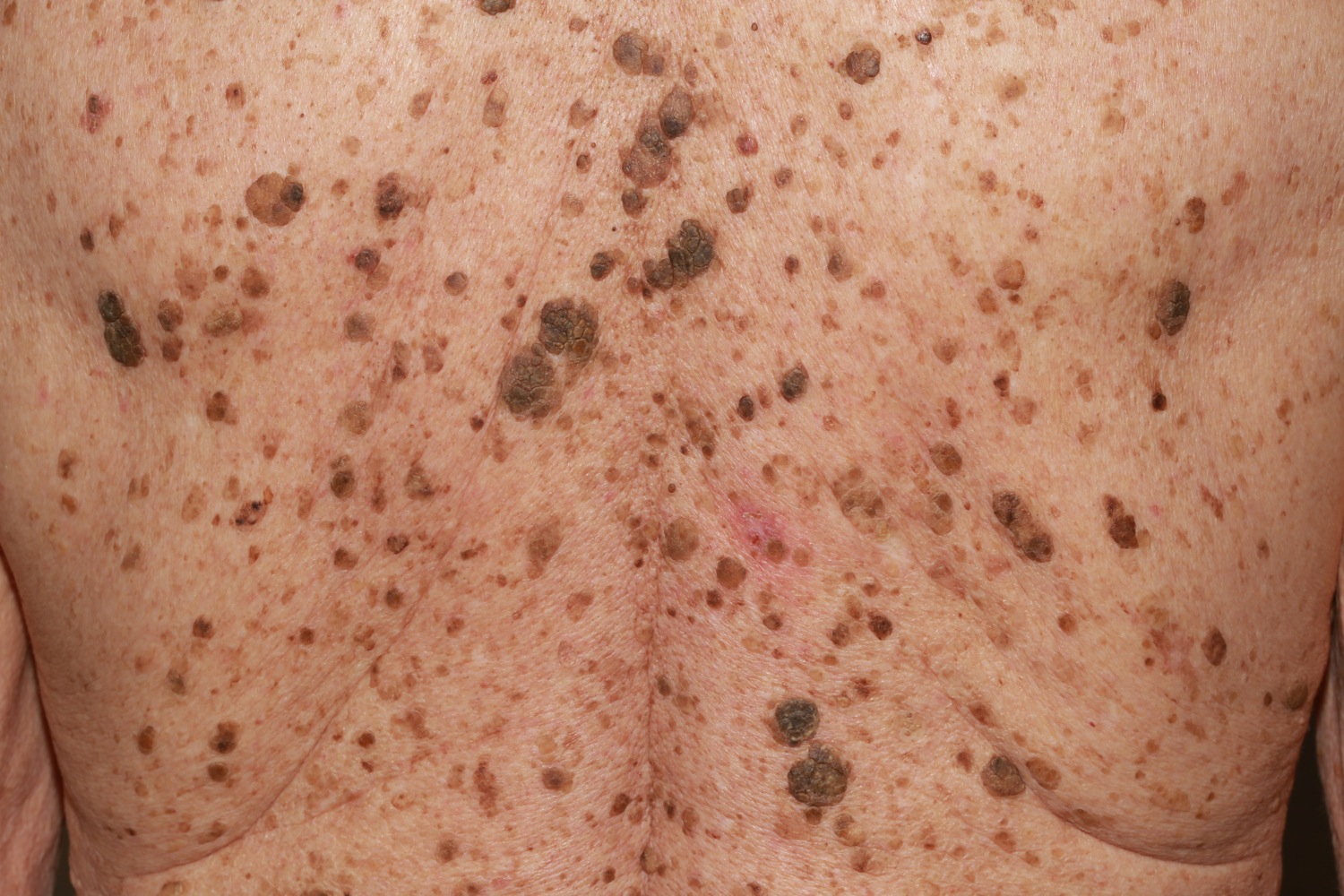 got mystery wart like growths they may be seborrheic keratoses