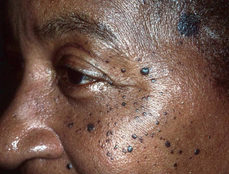 dark spots archives the