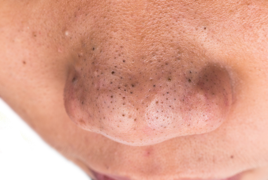 Image result for blackheads african