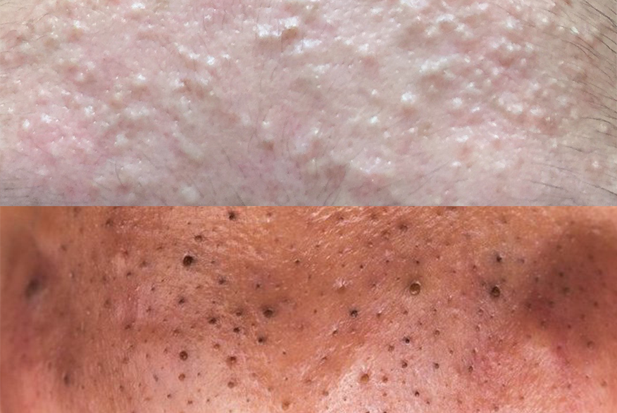 large-blackhead-removal